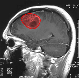 Uma imagem de ressonância magnética do cérebro de um paciente com um tumor destacado em vermelho.