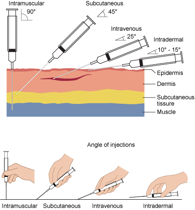 Needle-insertion-angles-1.png